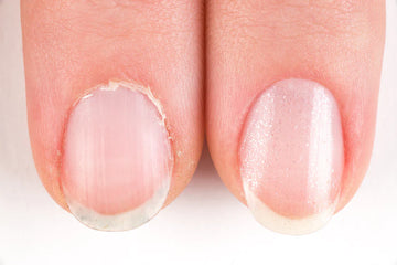 Hautknibbeln und Nägelbeißen