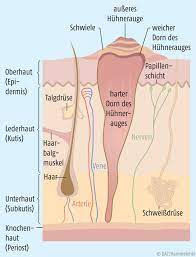 Hühnerauge Clavus - Verhornungsstörung auf knochennaher Haut